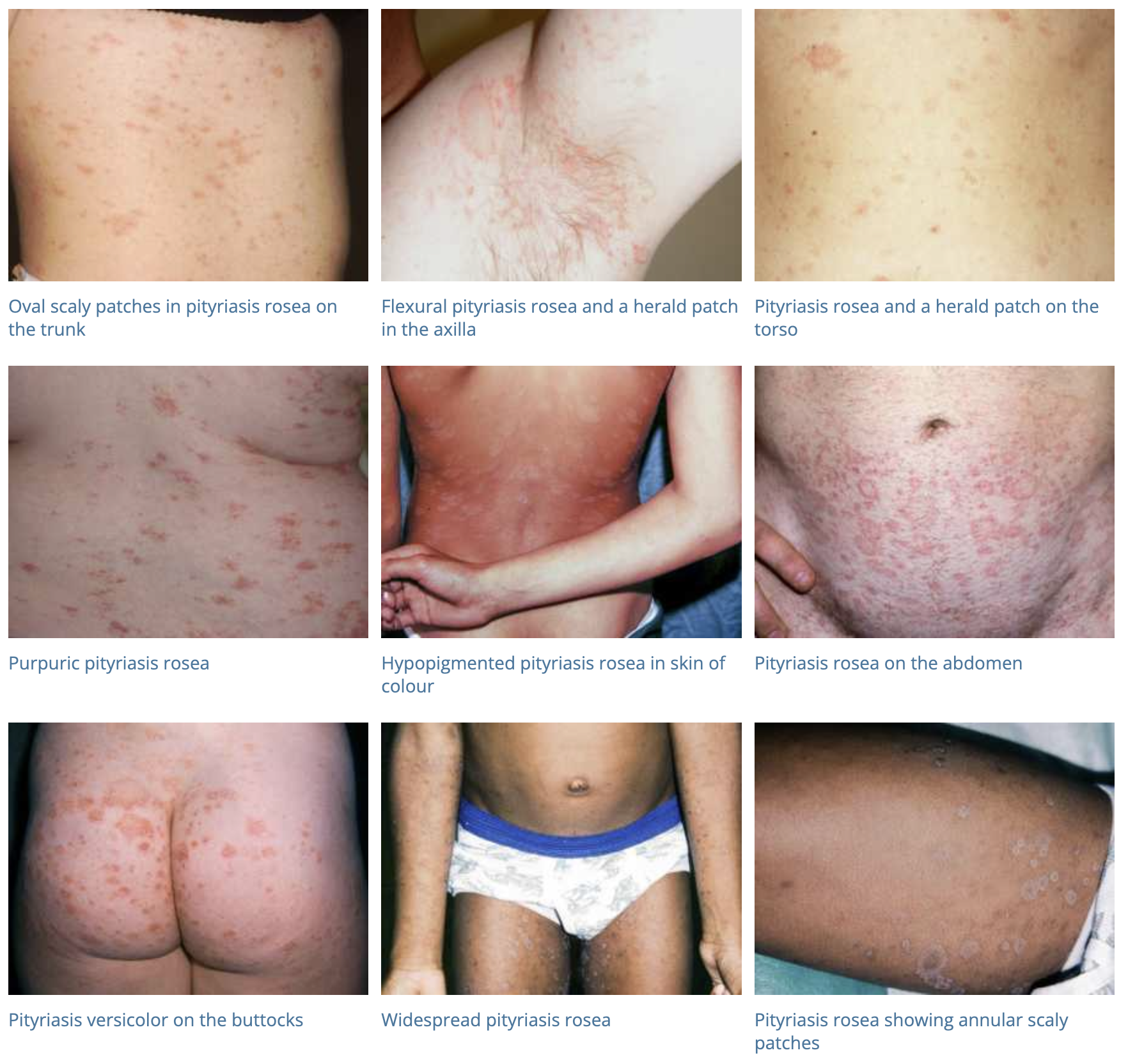 Pityriasis Rosea - Advanced Skin and Laser Center