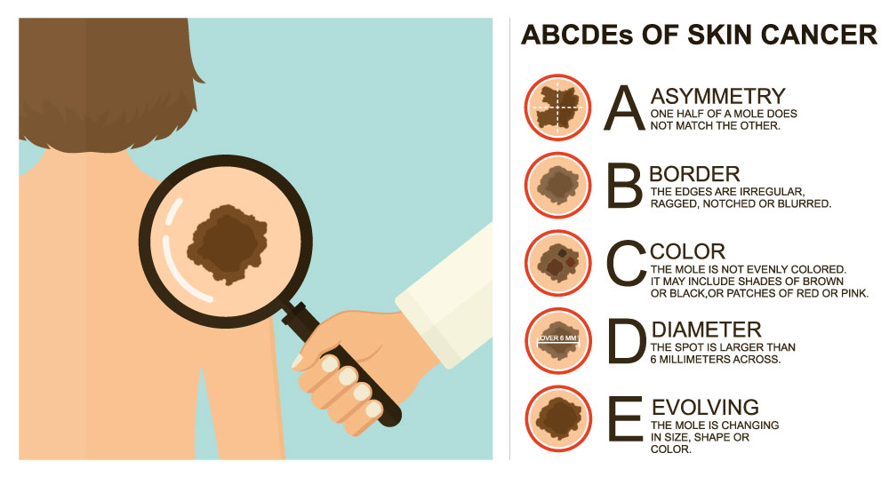 difference between melanoma and non melanoma