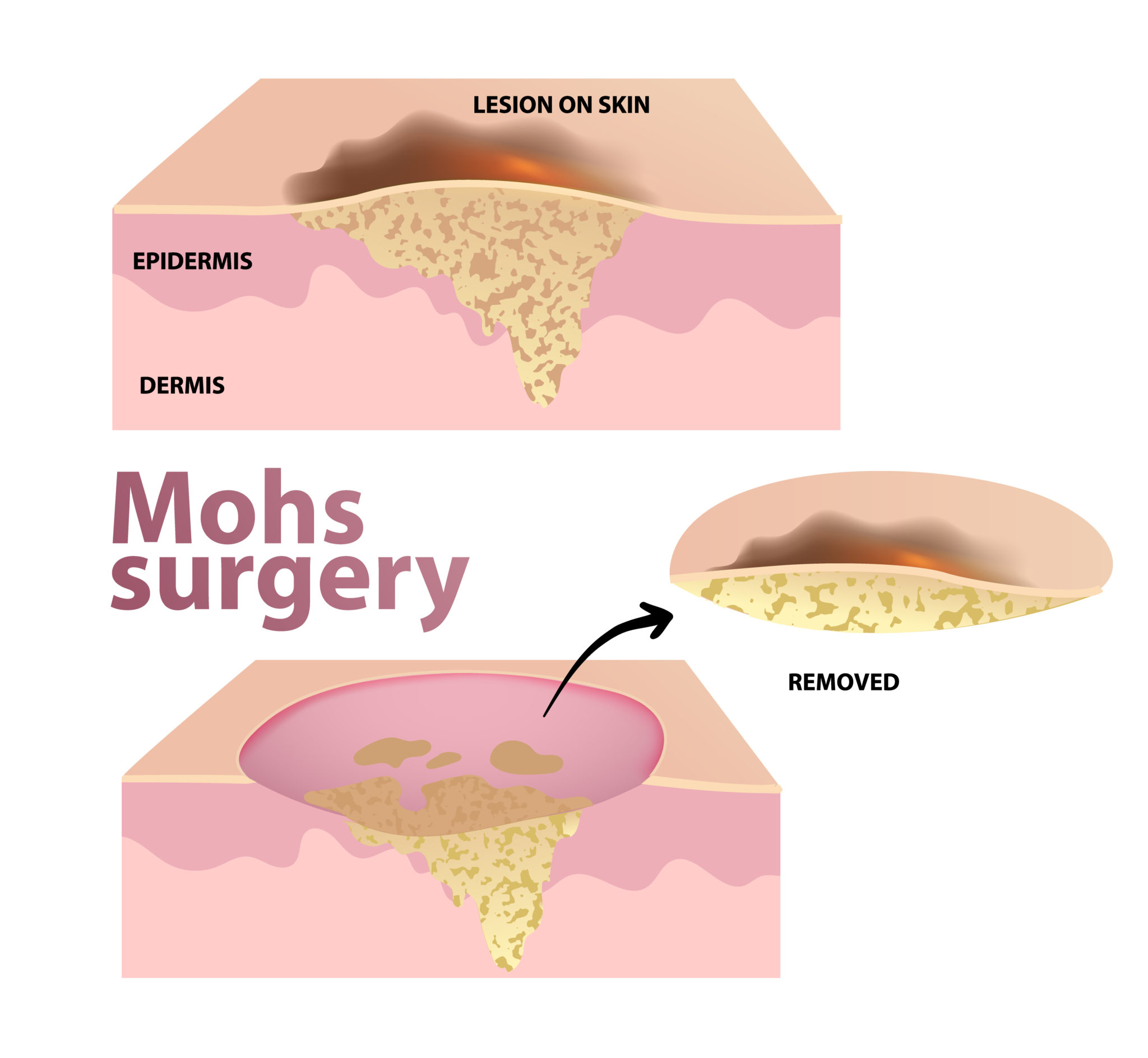 mohs-micrographic-surgery-advanced-skin-and-laser-center