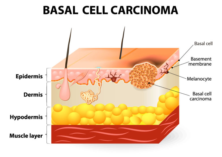 Basal Cell Carcinoma (BCC) Advanced Skin and Laser Center