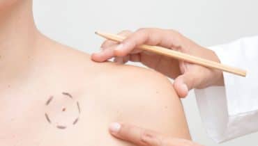 superficial radiation therapy brentwood tn