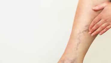 spider vein treatment near me brentwood tn