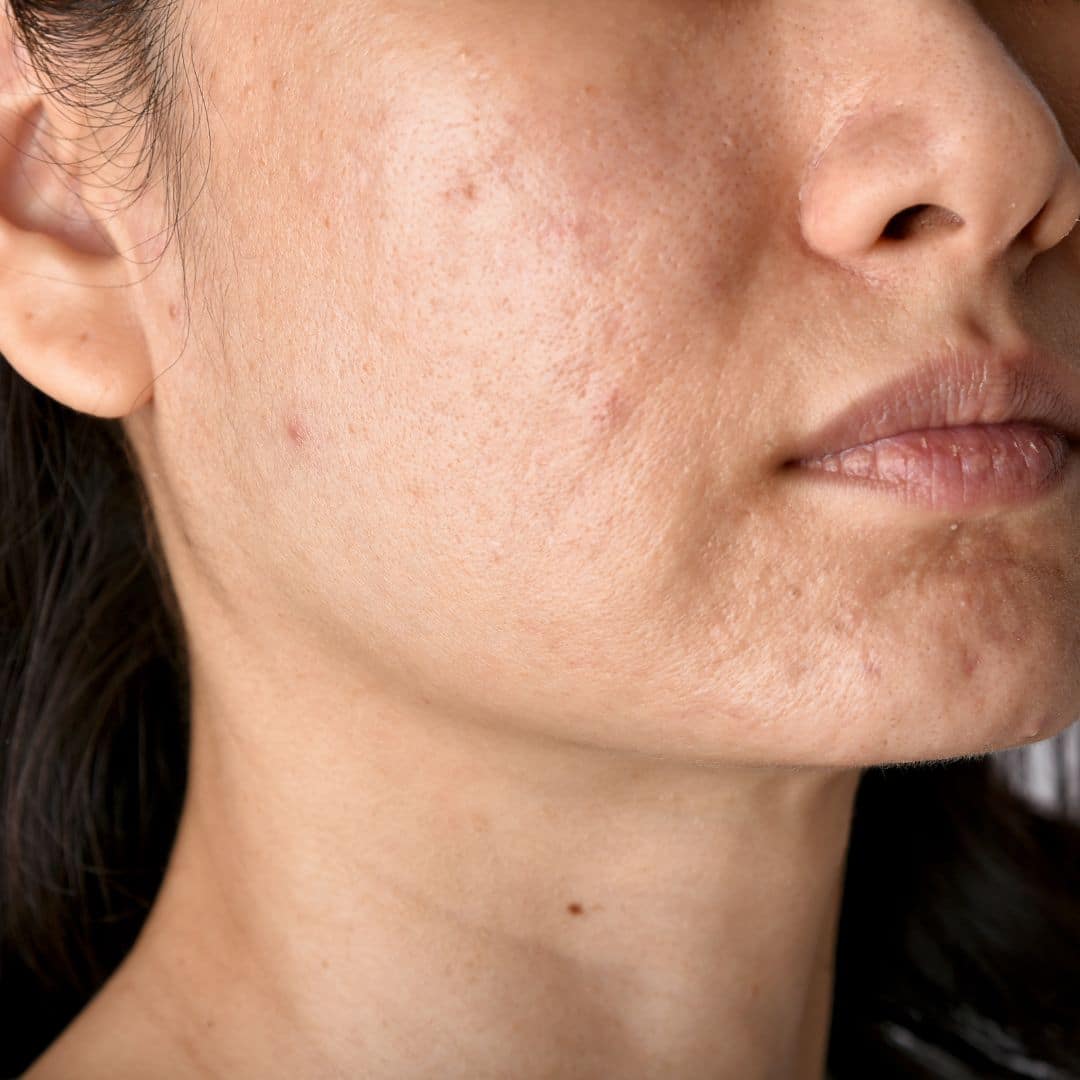 treatments for acne scars brentwood tn
