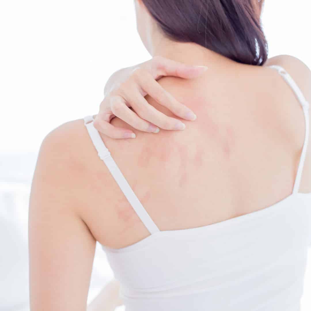 eczema treatment nashville