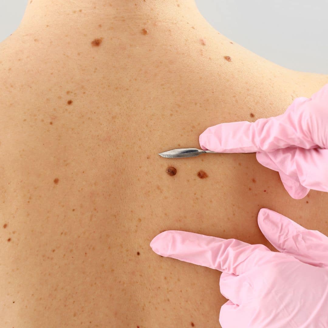 cost of mole removal in nashville