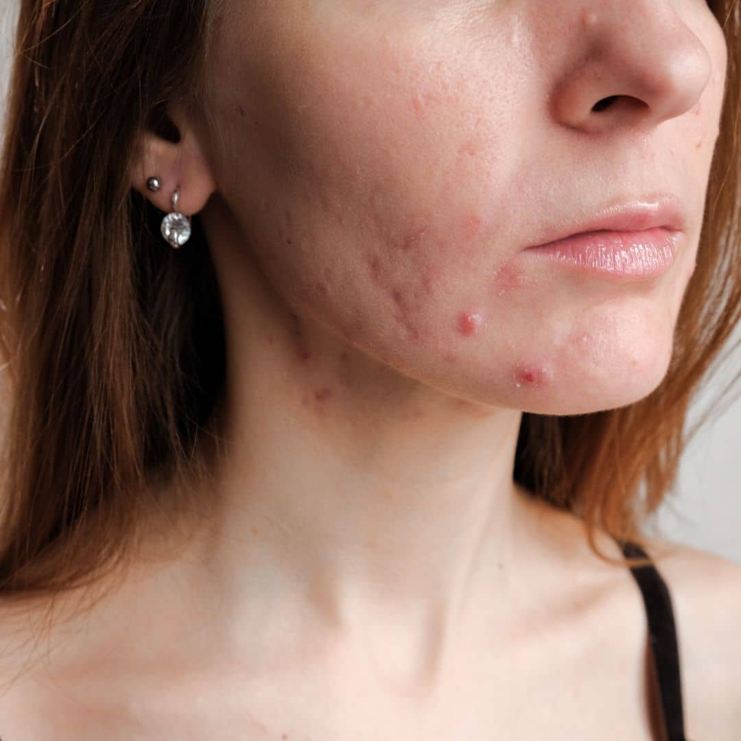 stress related acne treatment in nashville
