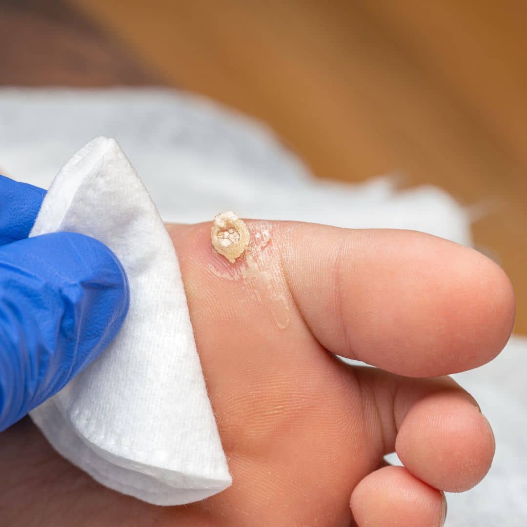 wart treatment in nashville