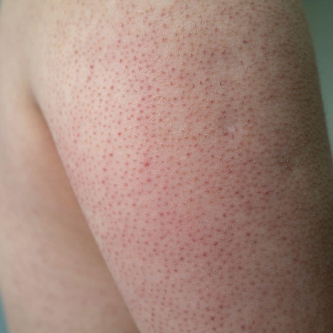 Keratotis Pilaris treatment in nashville