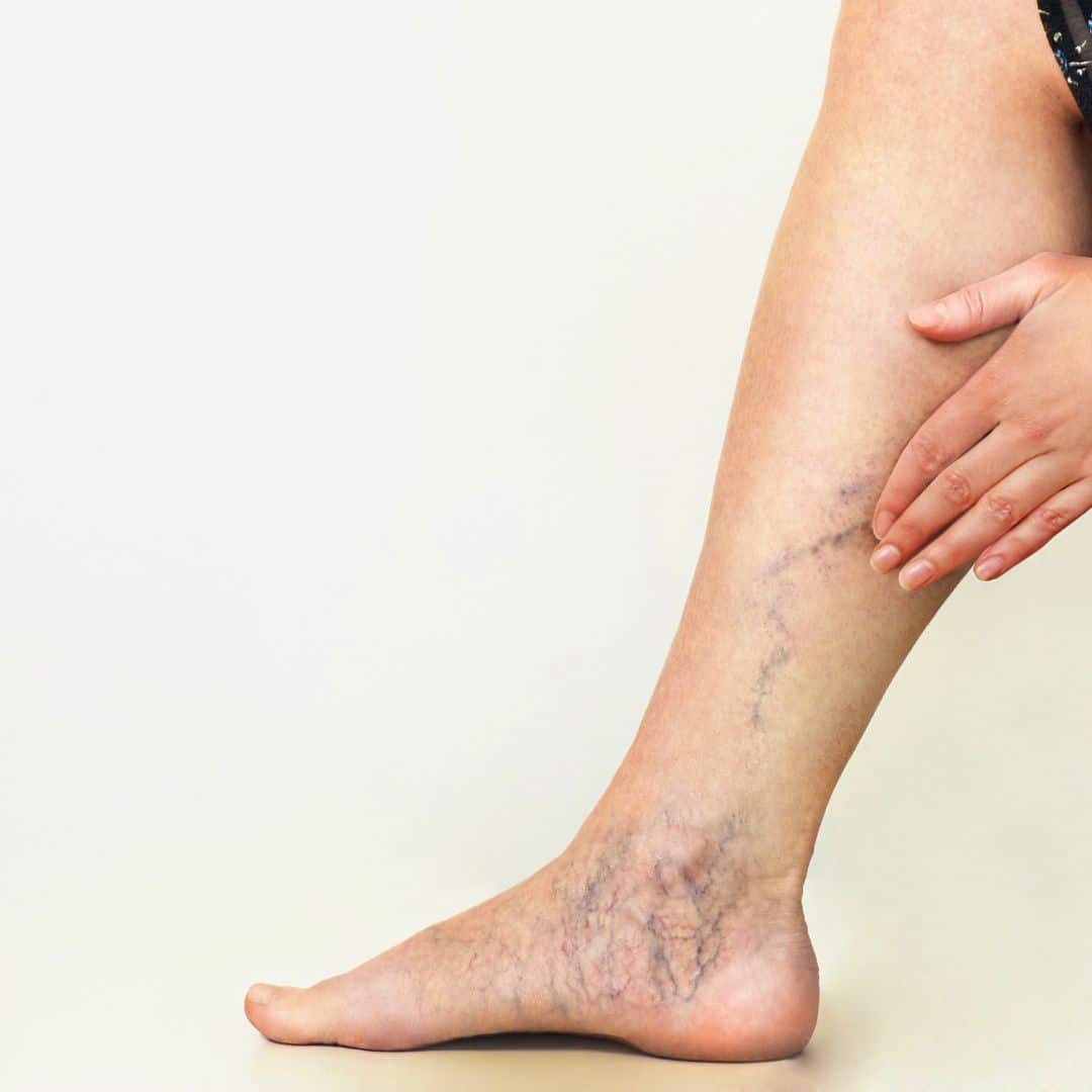 sclerotherapy in nashville