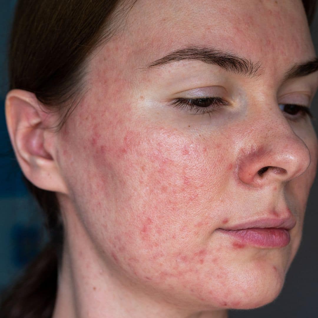 rosacea treatment brentwood tn