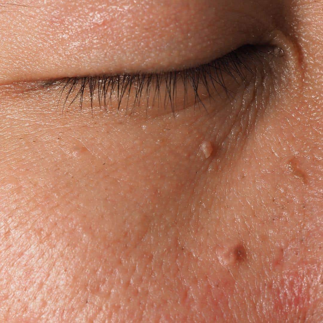 skin tag removal brentwood tn