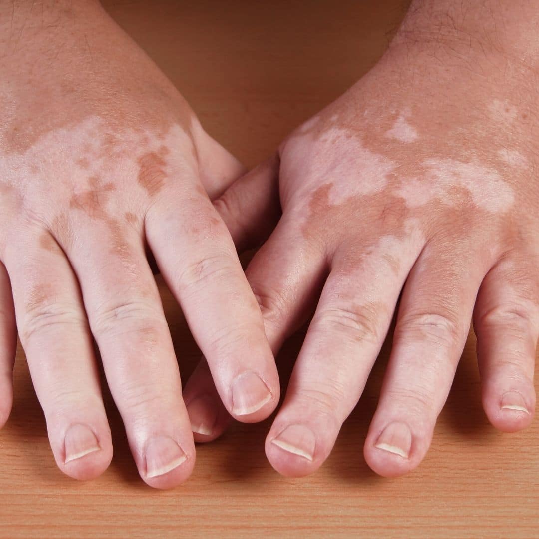 vitiligo treatment in nashville