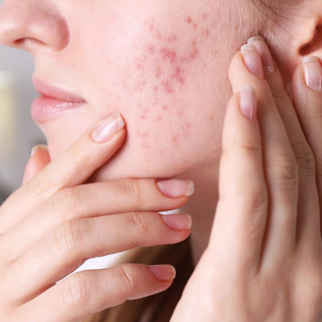 adult acne treatments nashville