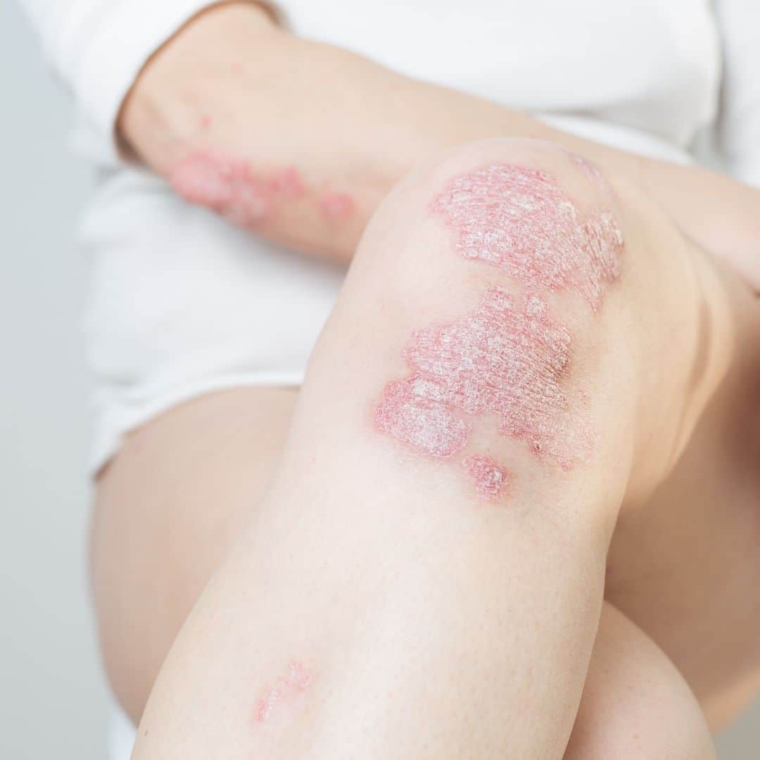 psoriasis treatment nashville
