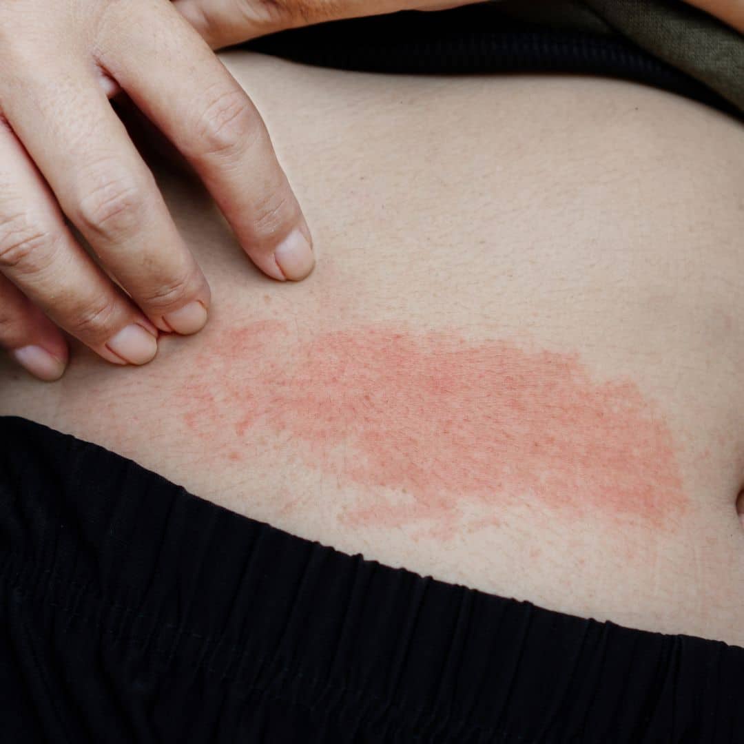 brentwood dermatologist for skin infections