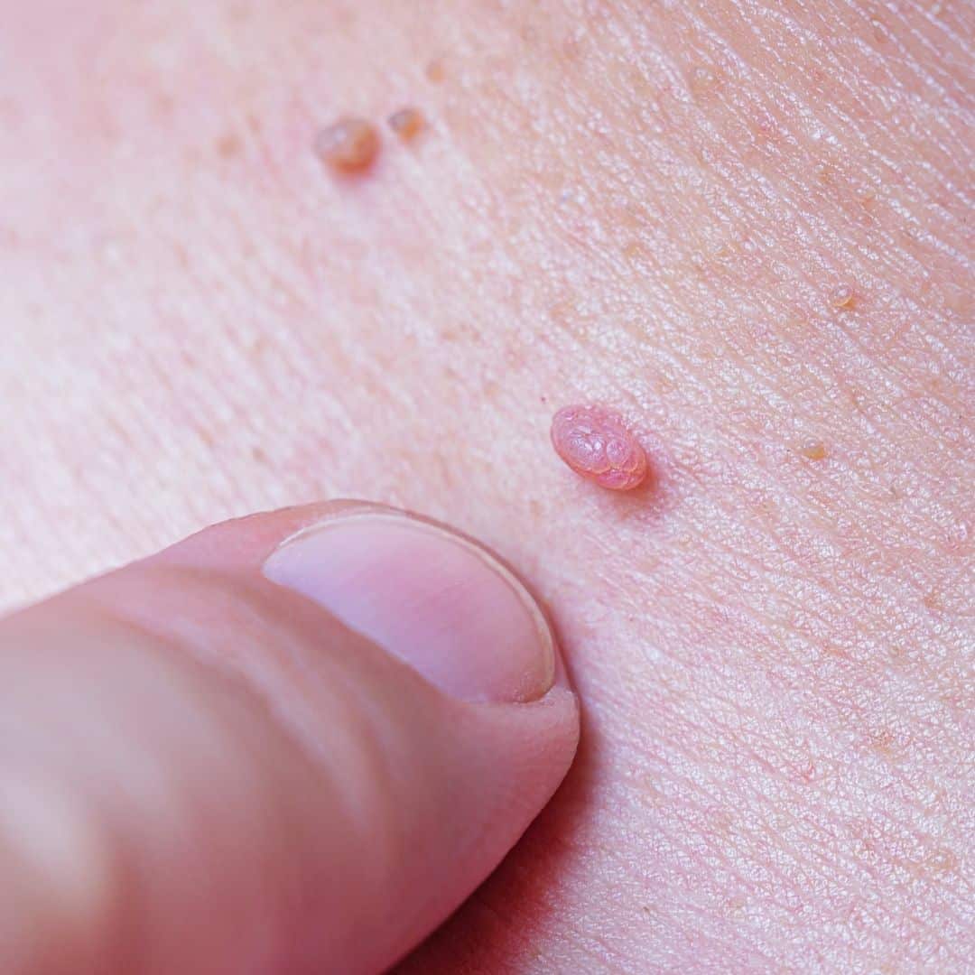 wart removal in brentwood tn