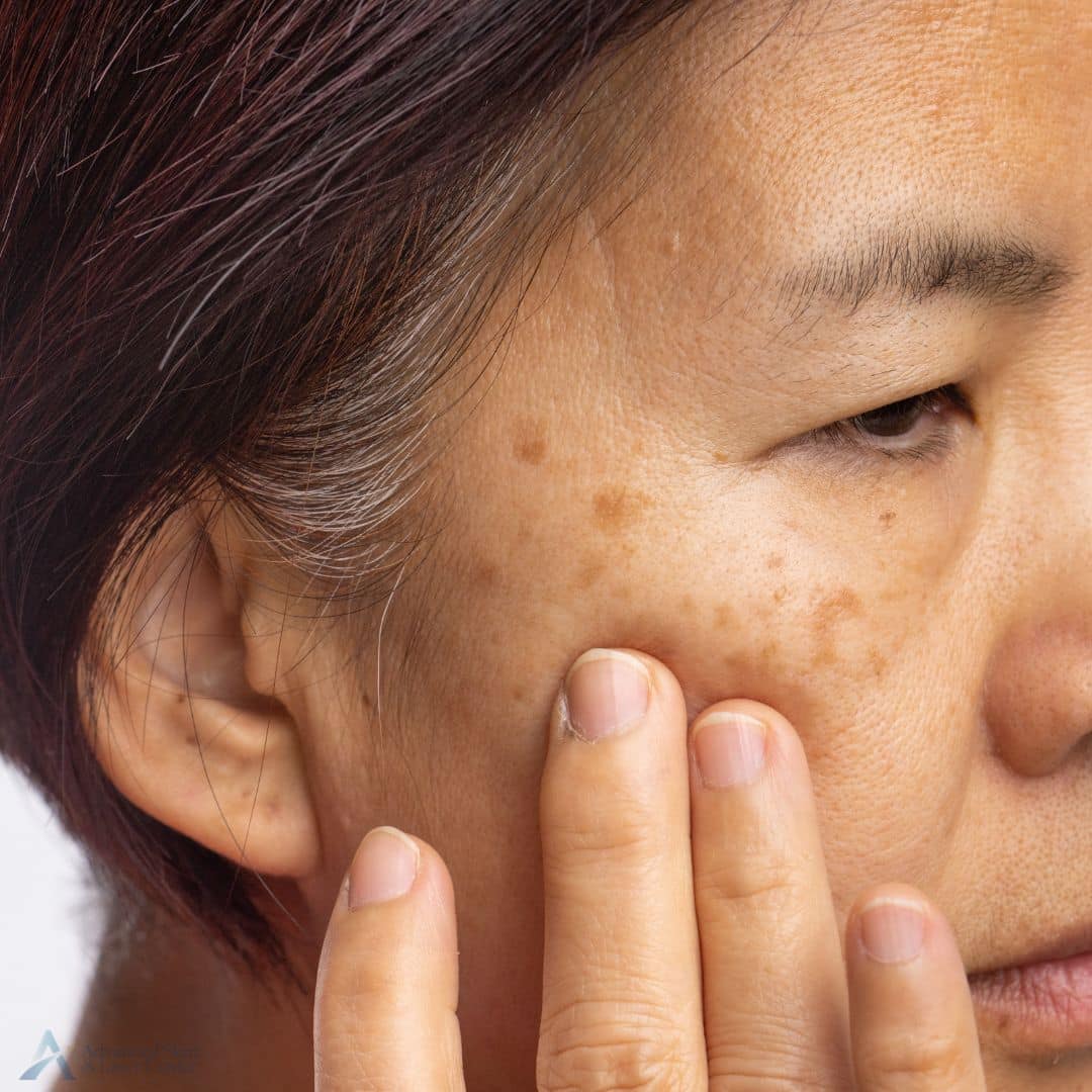 melasma treatment in brentwood tn