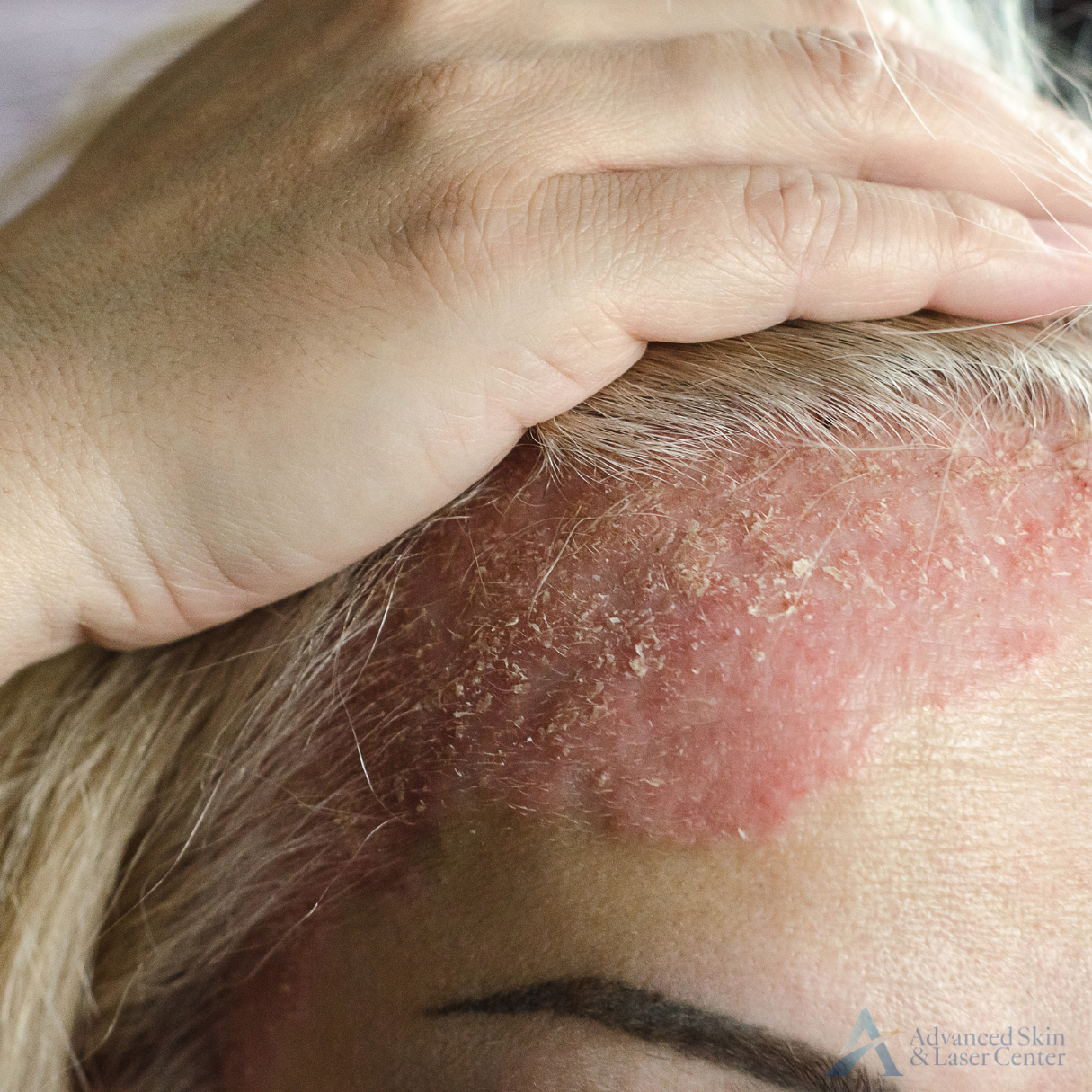 psoriasis treatment in brentwood tn