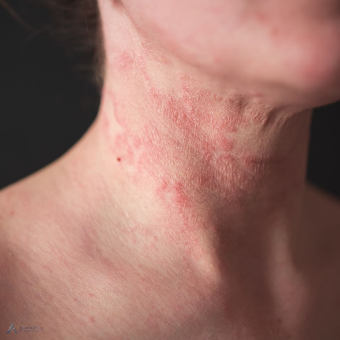 eczema specialist nashville