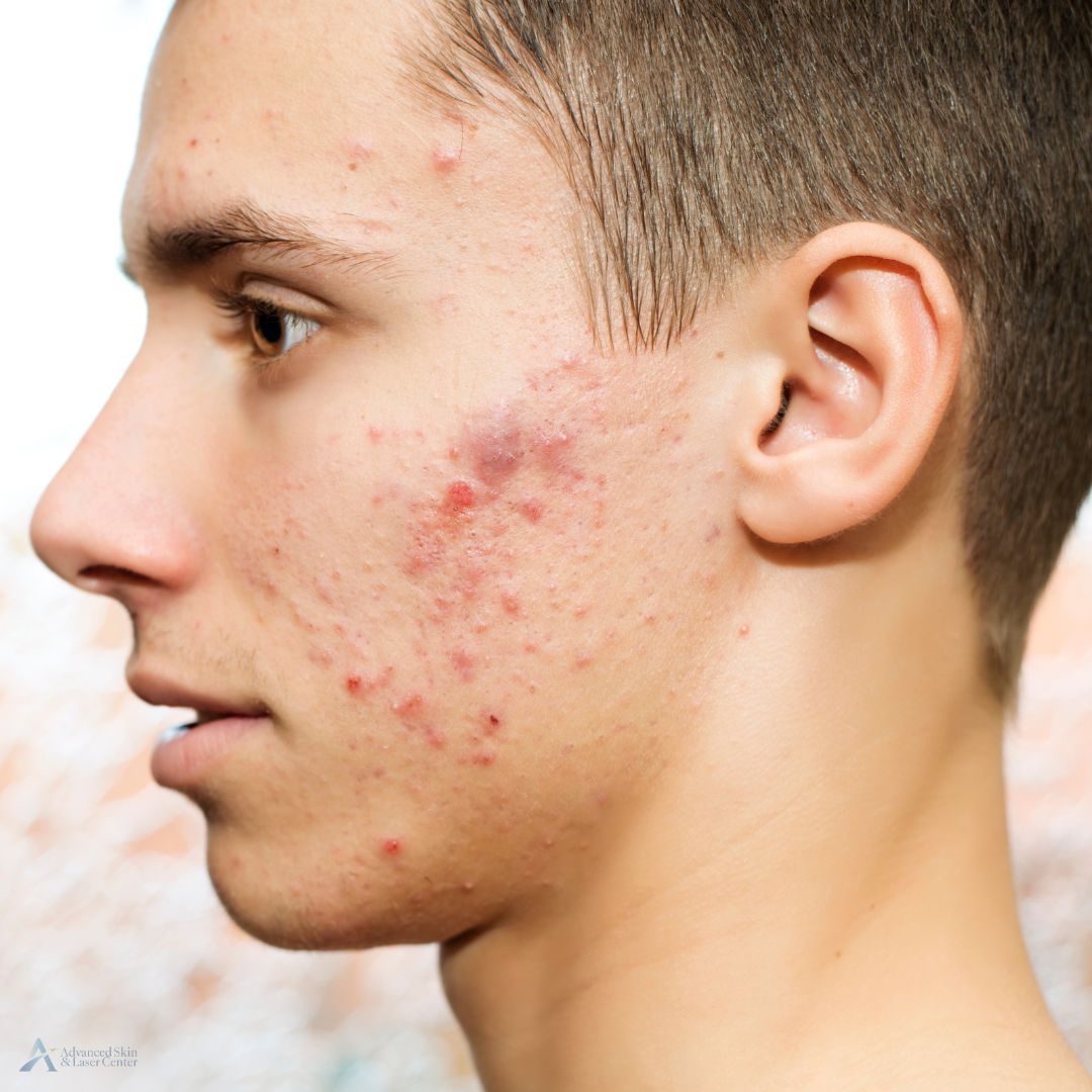 laser acne treatment nashville