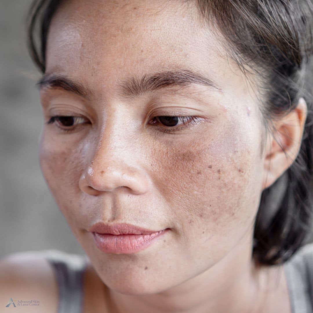 melasma laser treatment nashville
