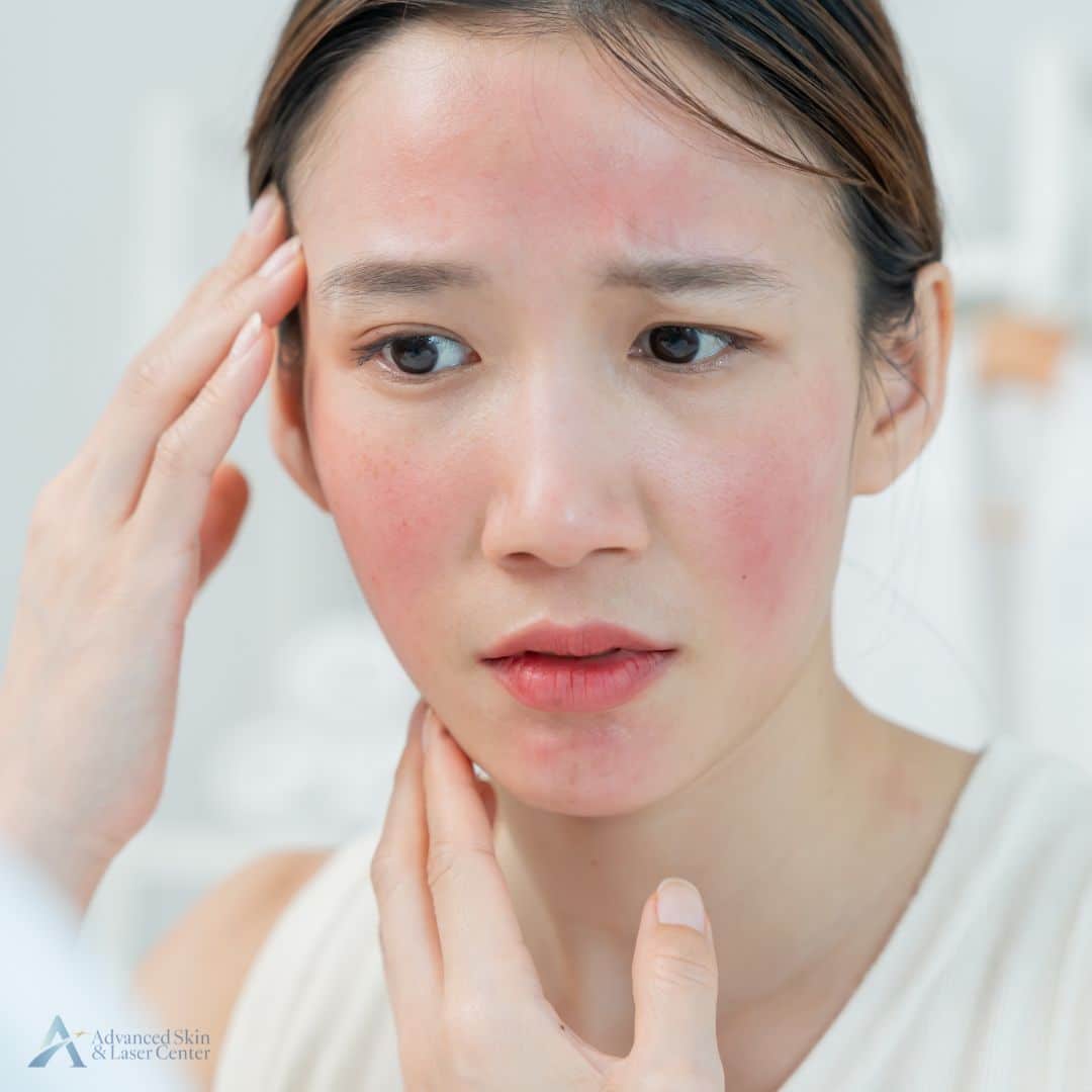 rosacea laser nashville tn