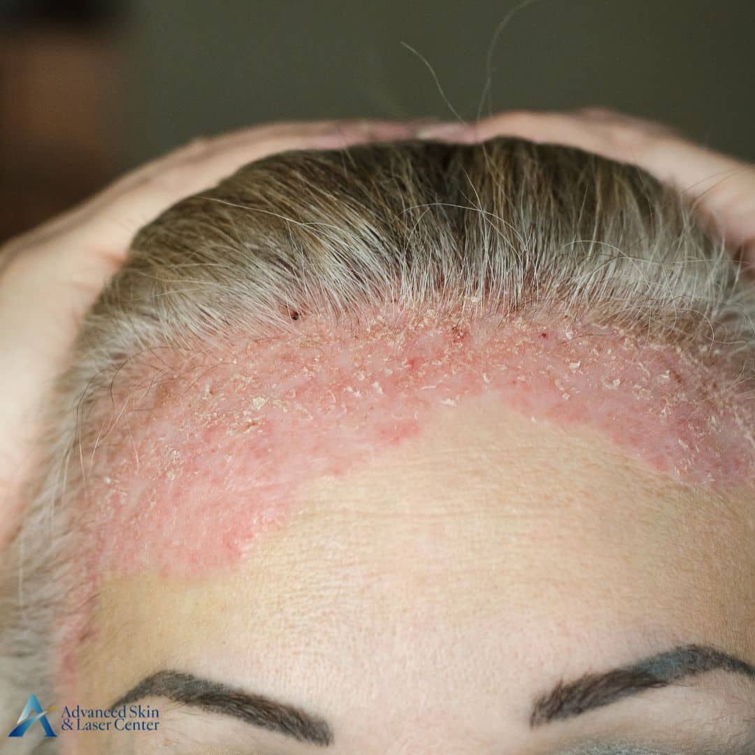 doctor to see for psoriasis in nashville