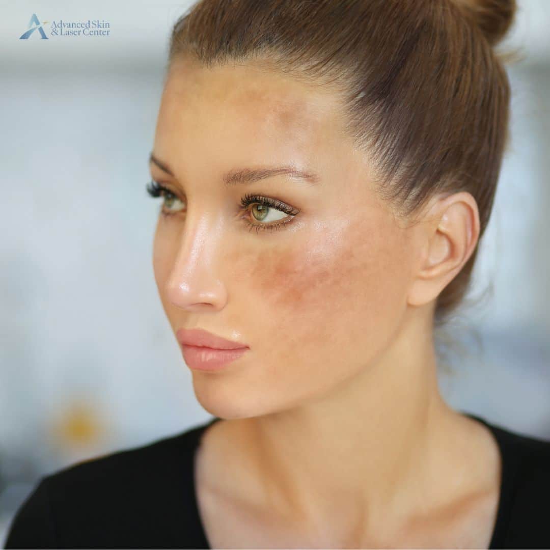 Pigmentation Correction Laser Treatments in Nashville